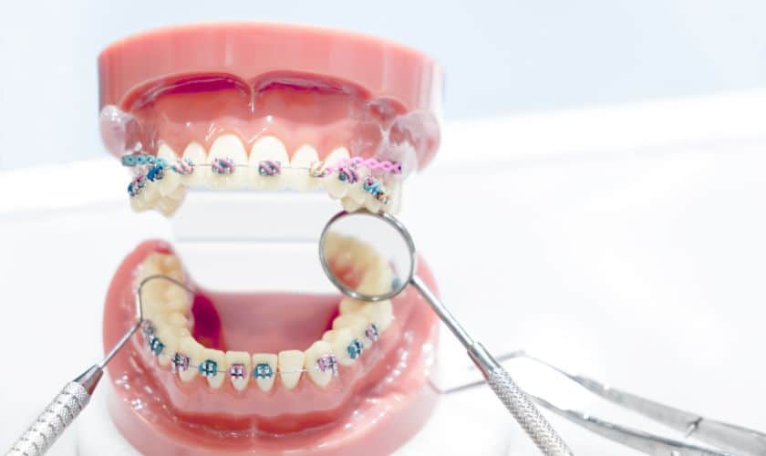 orthodontic treatment spring