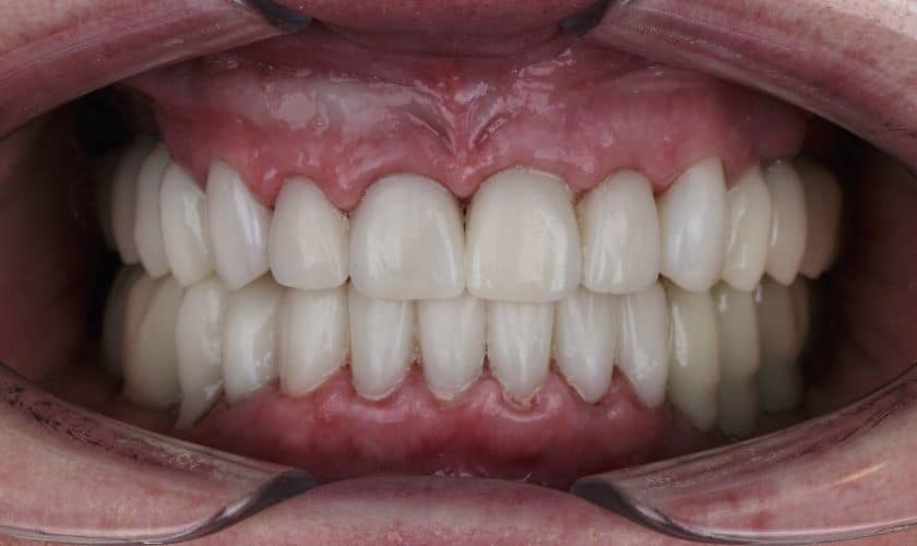 Say Goodbye To Gaps: Transform Your Smile With Restorative Dentistry