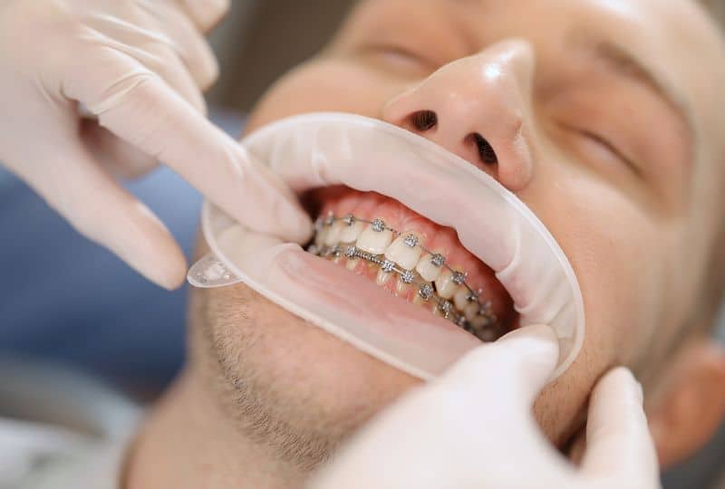 Dentist's Guide To Straightening Your Smile With Orthodontics