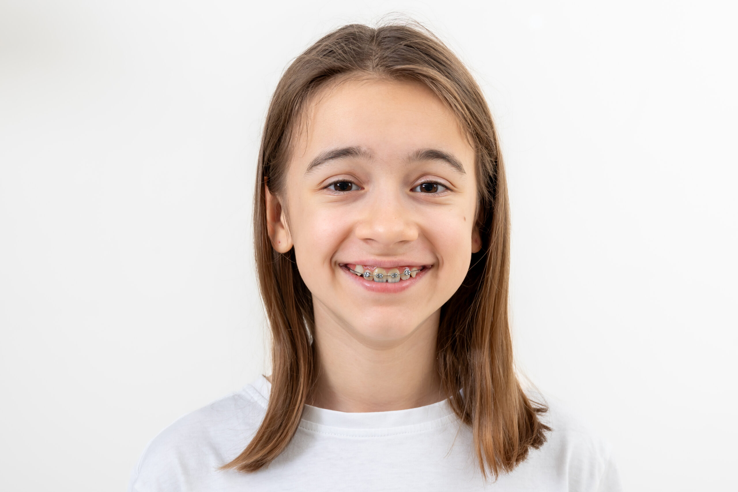 Child smiling with braces, showing clean teeth and healthy oral hygiene during orthodontic treatment