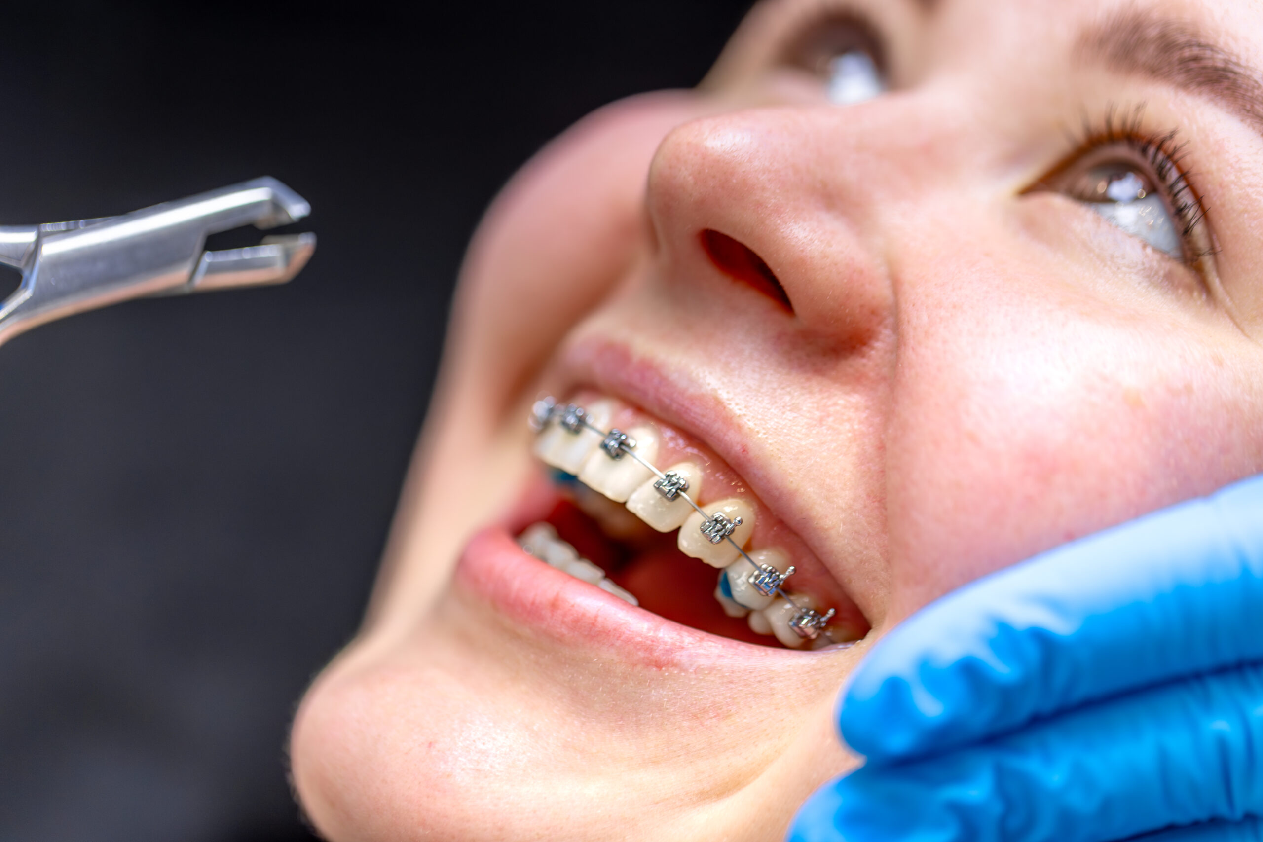 Patient getting braces placed, showing close-up of teeth with brackets and wire during an orthodontic visit