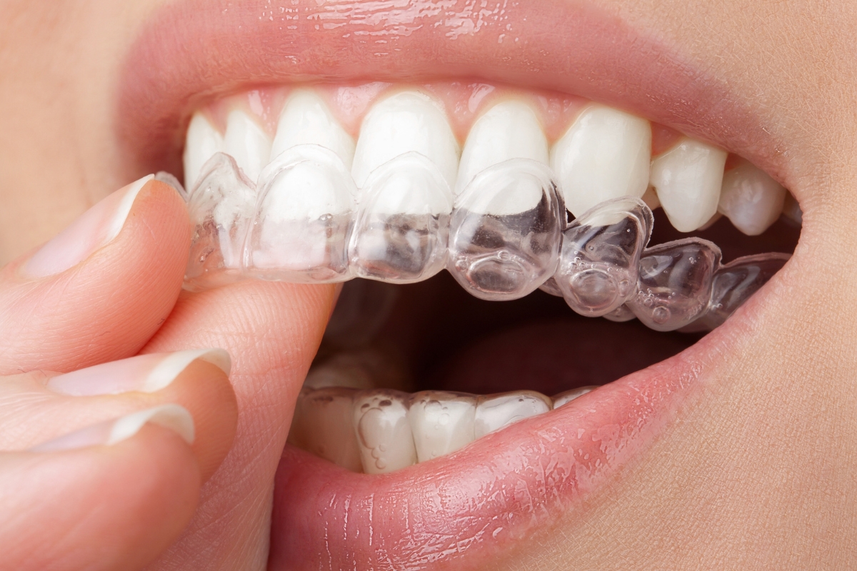Person removing clear Invisalign aligners for daily cleaning and care