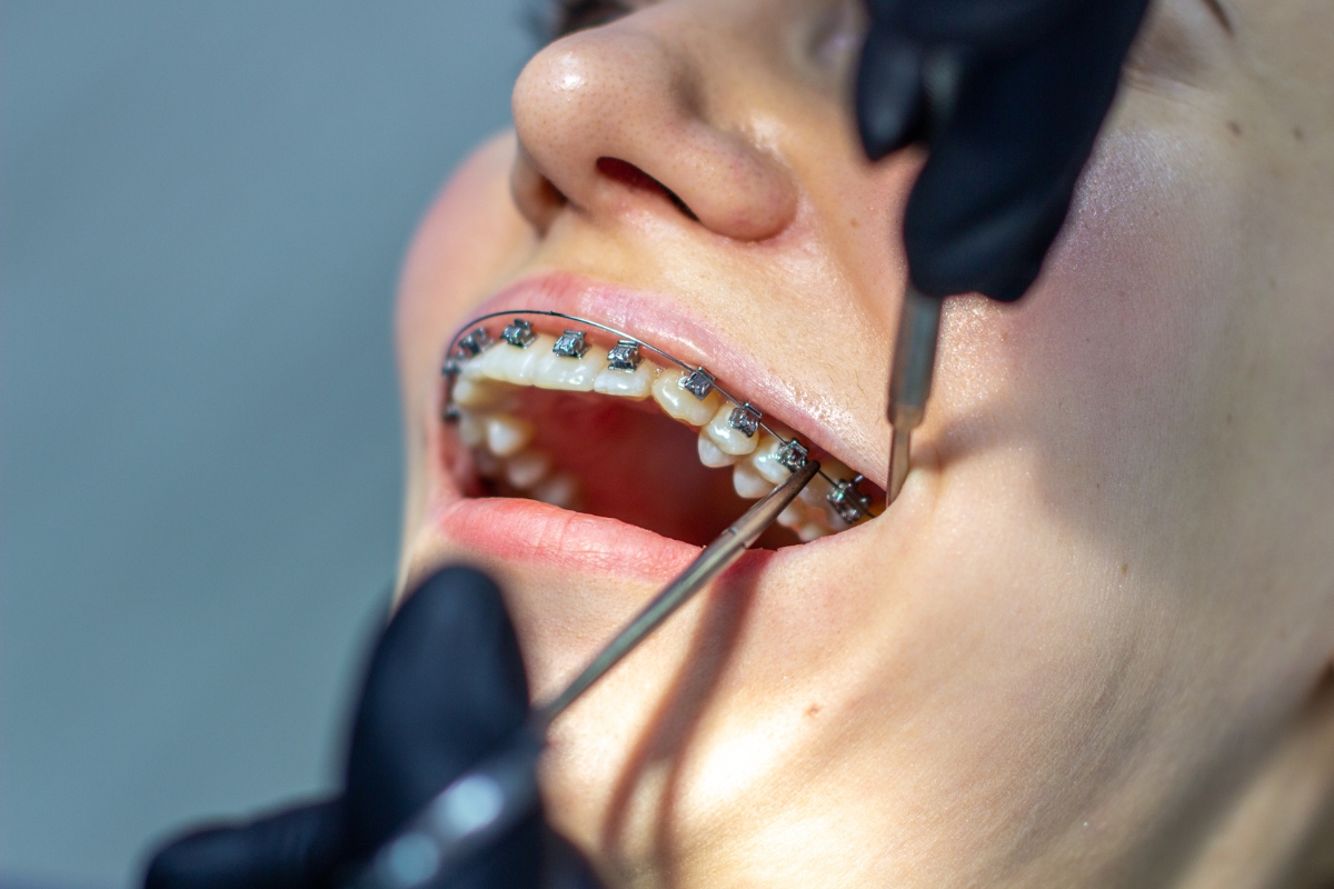 Teen patient receiving braces adjustment for overbite treatment in Spring TX